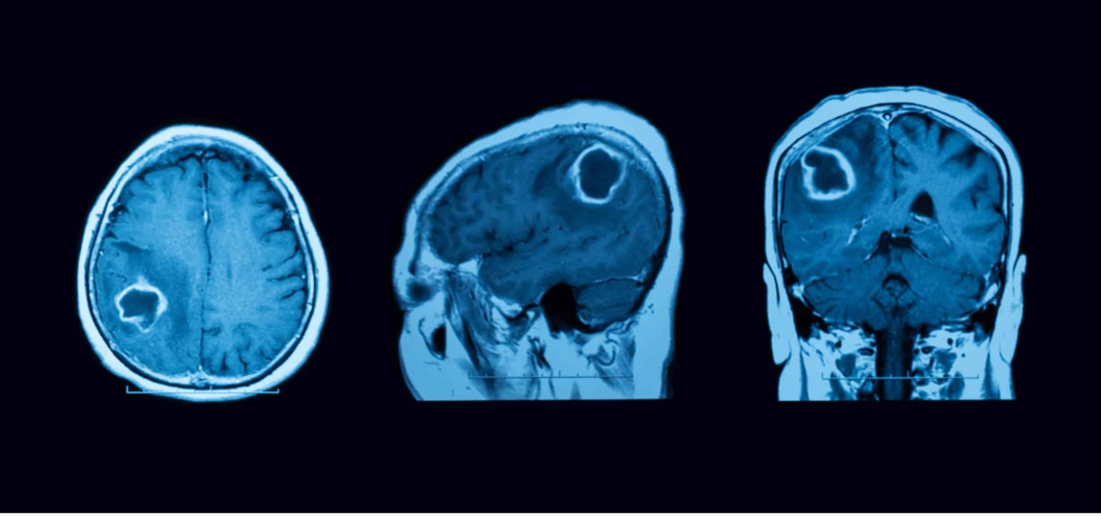 Brain Tumor: Symptoms, Signs & Causes